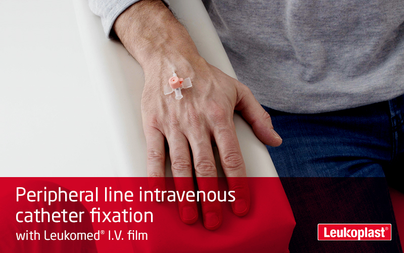 Denne film viser, hvordan et intravenøst injektionssted fastgøres med en I.V.-bandage. Vi ser, hvordan en sundhedsperson påfører Leukoplast I.V.-film på en patients håndryg og fastgører et kateter. Denne film viser, hvordan et intravenøst injektionssted fastgøres med en I.V.-bandage. Vi ser, hvordan en sundhedsperson påfører Leukoplast I.V.-film på en patients håndryg og fastgører et kateter.